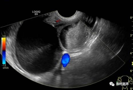 卵巢畸胎瘤超声图像图片