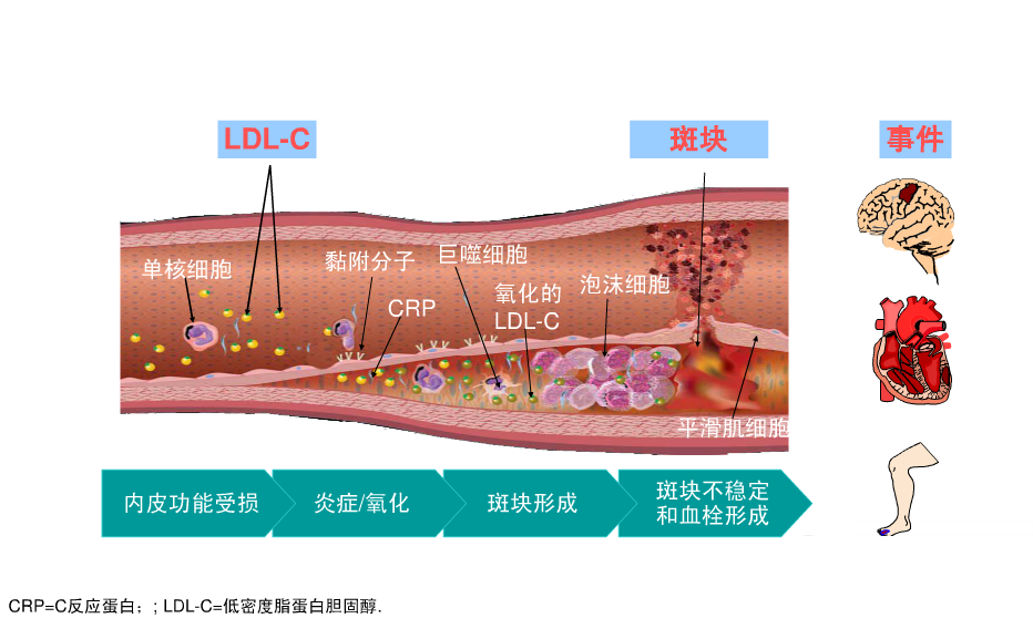 动脉粥样硬化后降脂药要服多久血脂正常了还需要继续服药么