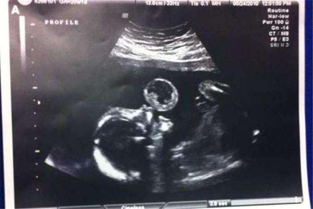 五个月大的胎儿图片图片