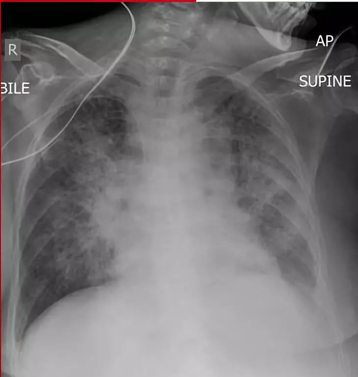 扒一扒丨影像医生最需要警惕的那些异常胸片征象附22个胸片中常见的
