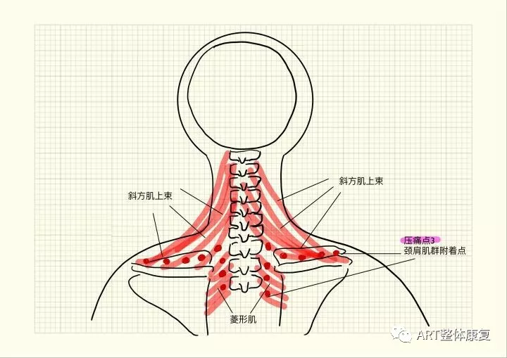 第三个区域为背后肩部和颈后侧的交界区域和锁骨上窝和颈部前侧的交界