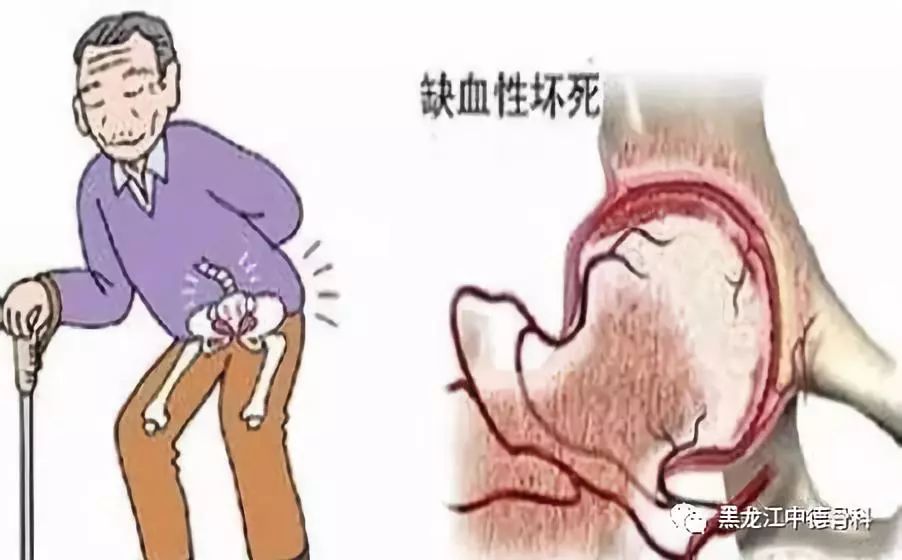 大腿根疼是不是得了股骨頭壞死呢