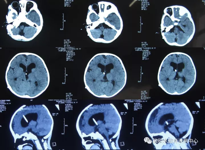落日征脑积水图片