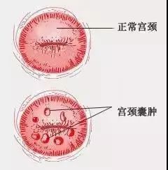 宮頸上長痘痘了首先,這個囊腫通常狀況下是不會癌變的,宮頸tct和hpv是