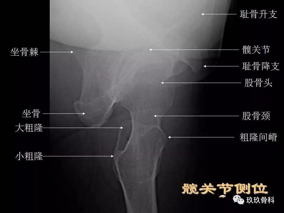 髋关节ce角测量示意图图片