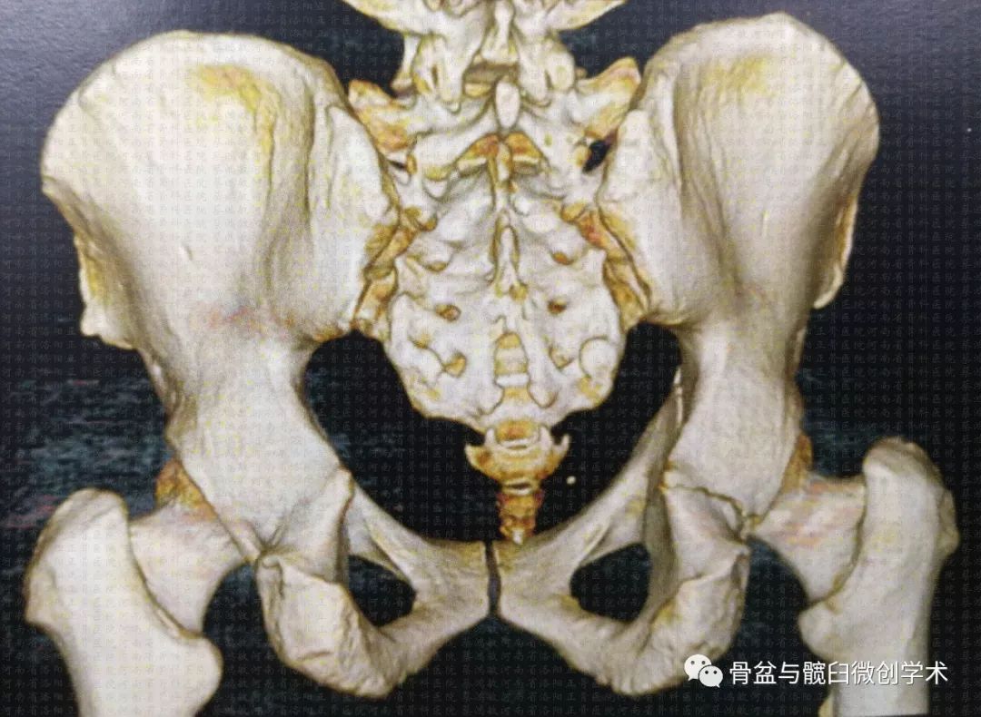 髖臼橫形骨折的微創治療經皮前柱後柱螺釘置入手術