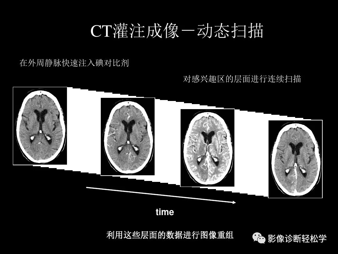 ct灌注成像图像解读图片