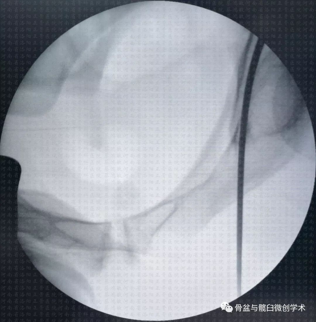 髖臼橫形骨折的微創治療經皮前柱後柱螺釘置入手術