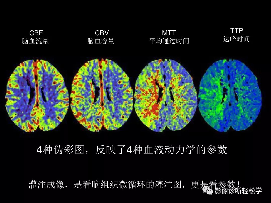 缺血性脑血管病的ctmr灌注成像