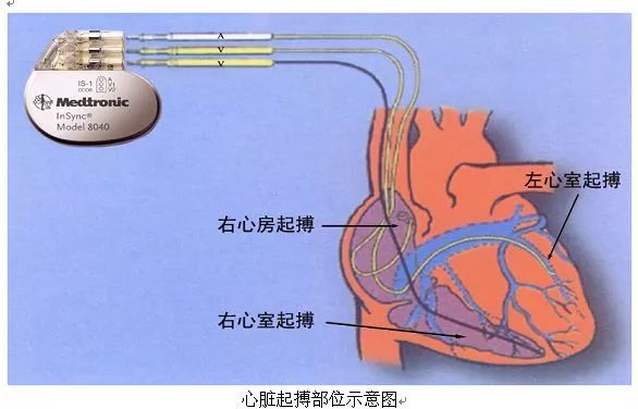 心脏起搏器装在哪里图片