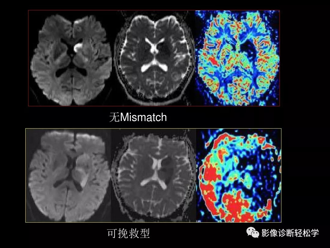 缺血性脑血管病的ctmr灌注成像