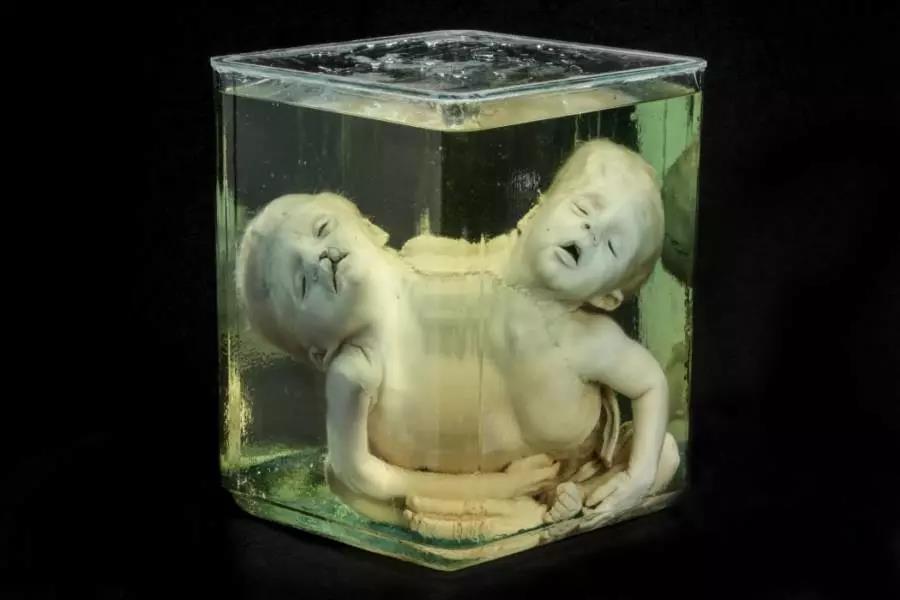 玻璃广口瓶中的畸形婴儿以及各式各样的器官标本