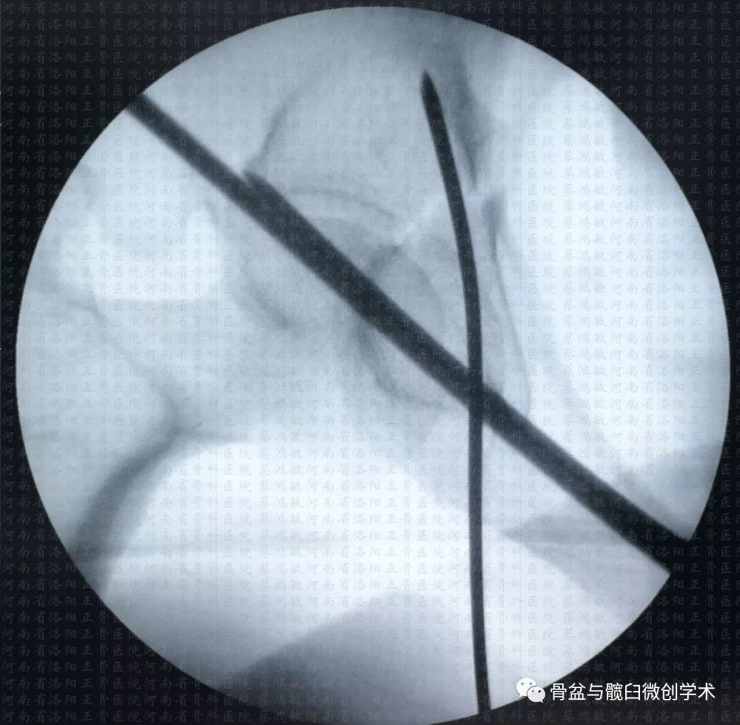 髖臼橫形骨折的微創治療經皮前柱後柱螺釘置入手術