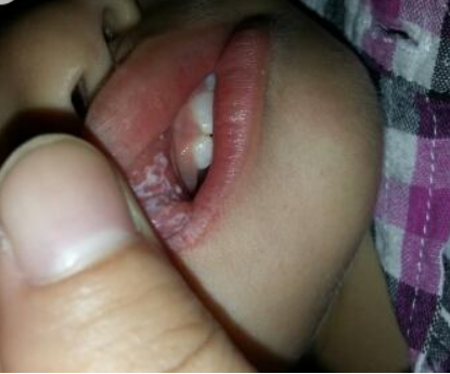 十个月宝宝口腔溃疡图图片