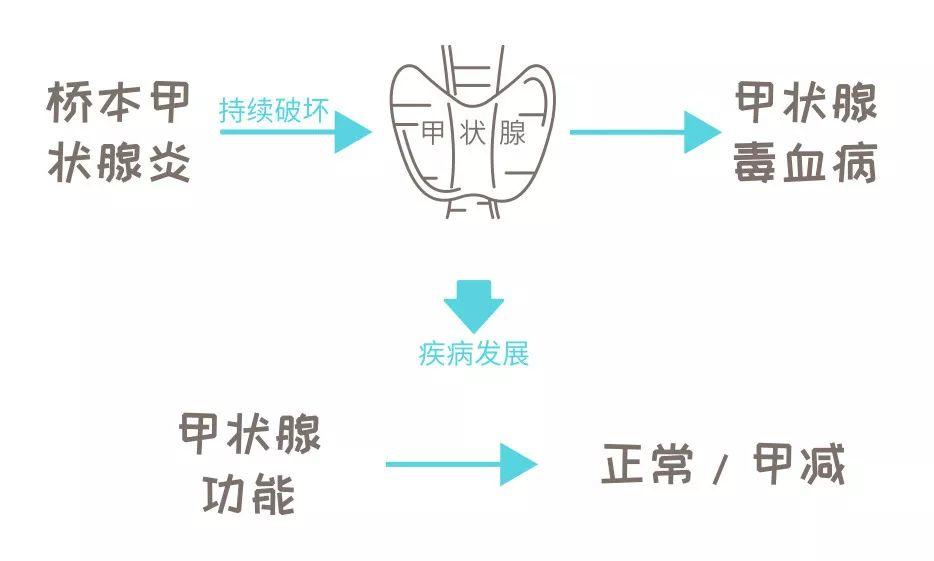 華西醫生告訴你橋本甲狀腺炎其實並沒有那麼可怕