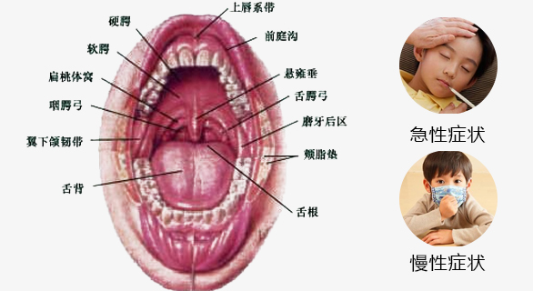 这些症状出现代表扁桃体炎已经不远了