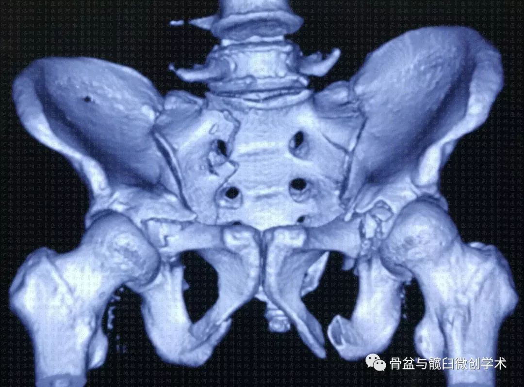 縣中醫院骨二科醫生運用骨盆微創治療技術解除複雜骨盆創傷病患部