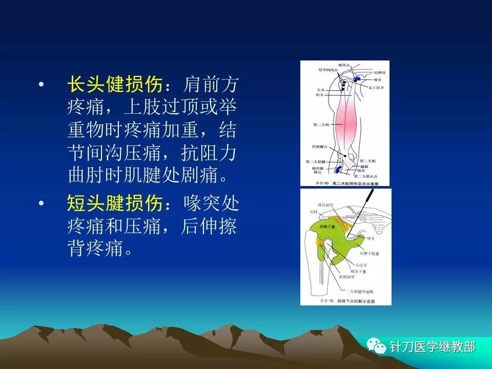 肩周炎標準針刀治療