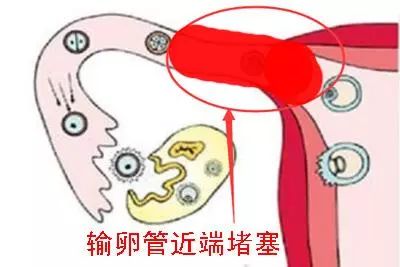 據悉,輸卵管粘連比較典型的症狀表現就是不孕,在不孕的女性人群中