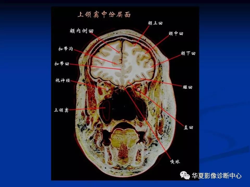 头颅磁共振解剖图谱图片