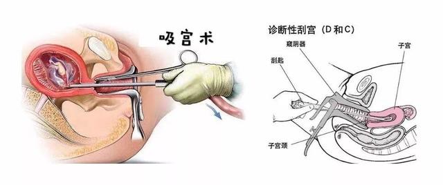 清宫手术过程图解图片