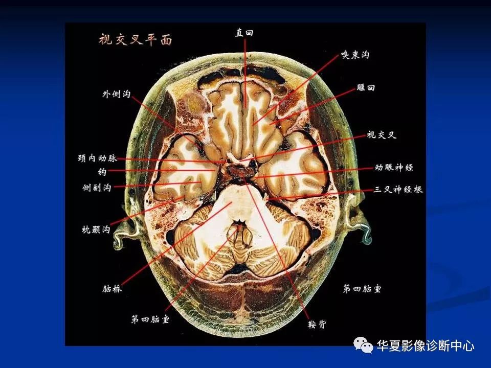 颅脑分叶断层解剖图图片