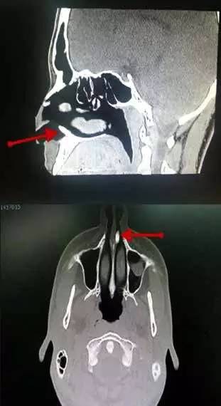 鼻腔內異位牙致反覆性鼻出血一例