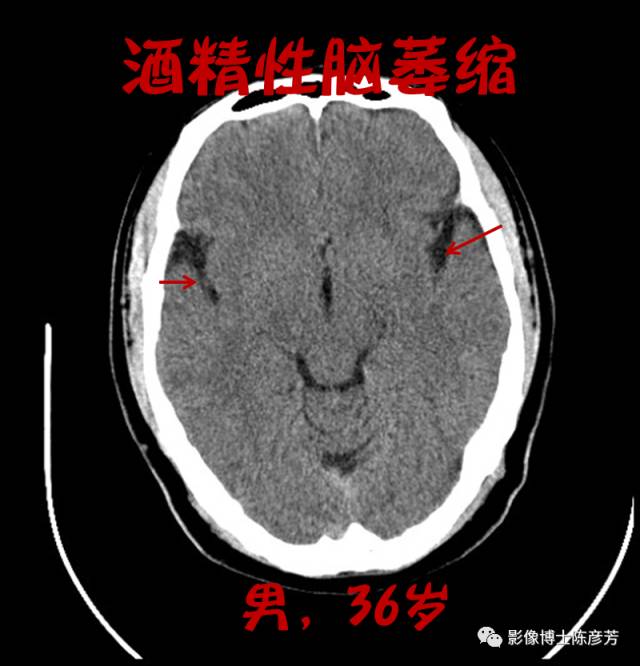 酒精性脑萎缩图片