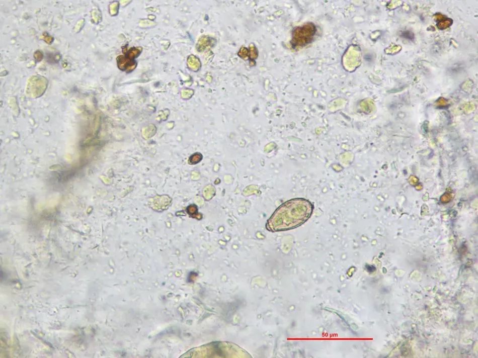 專家專欄 | 肝吸蟲卵vs靈芝孢子,你還傻傻的分不清嗎?_糞便