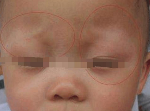 婴儿眉毛中间凹陷图片图片