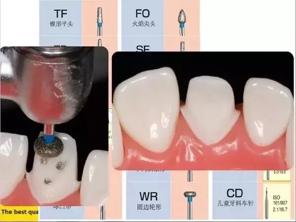 口腔二类洞制备步骤图片