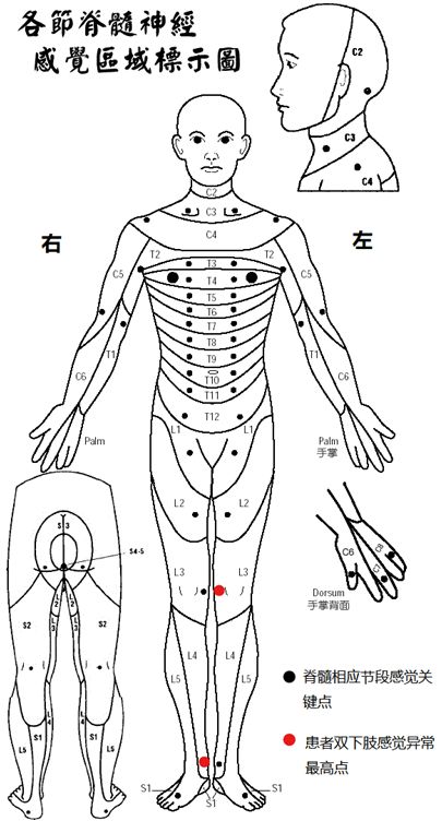脊髓损伤感觉关键点图片