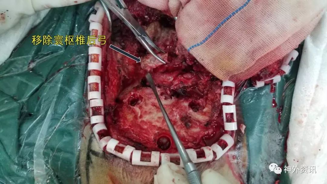 经乙状窦后联合远外侧入路切除岩斜