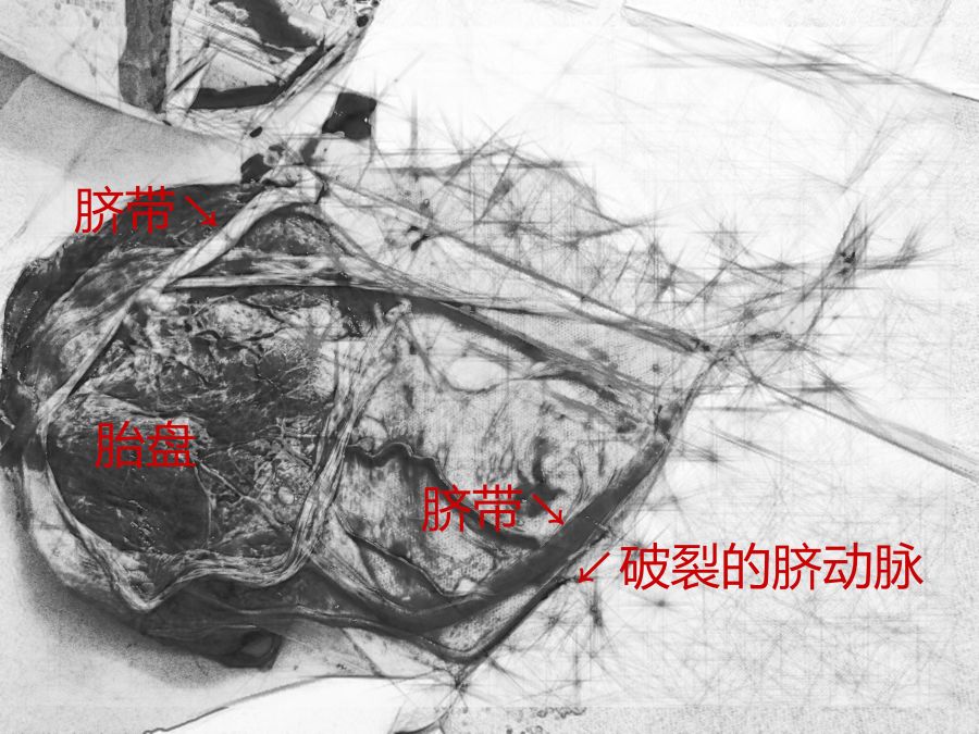 大血管破裂图片