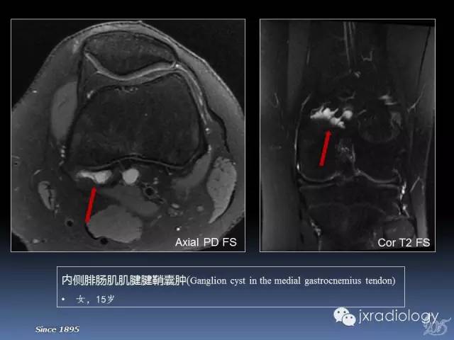 膝關節肌腱病變磁共振診斷