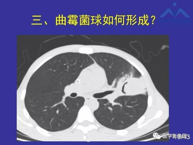 肺曲霉菌病的空气新月征ct诊断要素影像天地