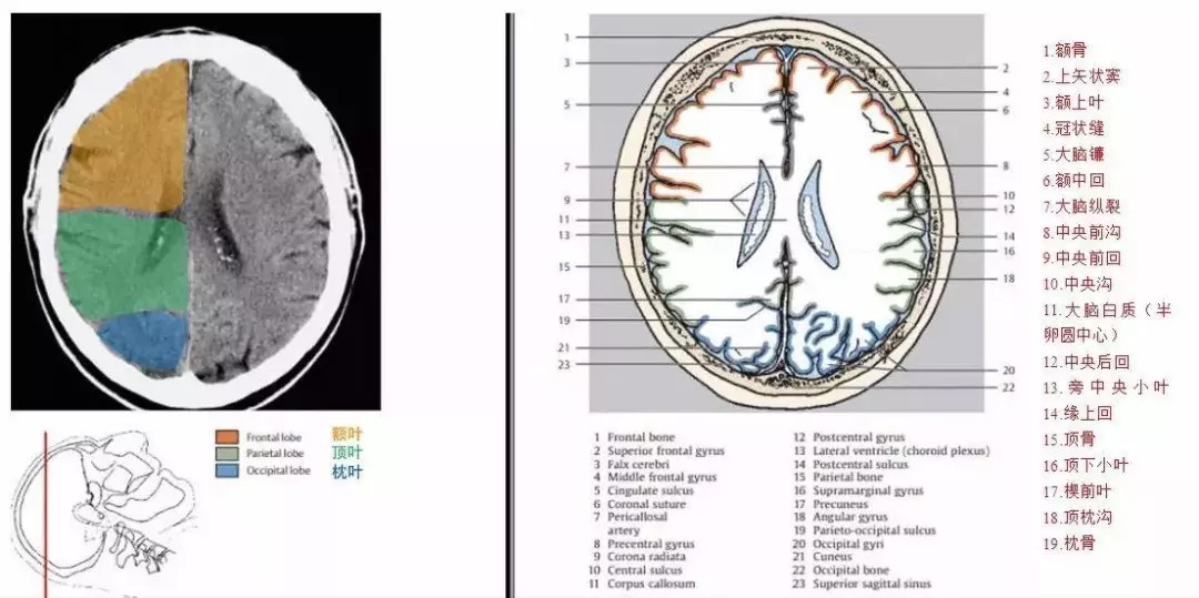 的横断层面及ct图经中央旁小叶的横断层面及ct图颅脑ct断面解剖图谱