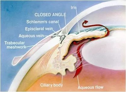 急性青光眼以閉角性為主,因引流角突然被阻塞,而造成睫狀體分泌的房水