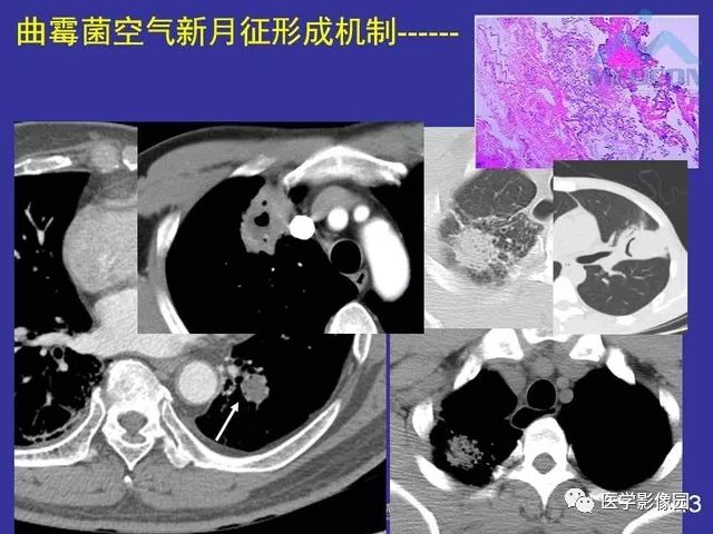 肺麴黴菌病的空氣新月徵ct診斷要素影像天地