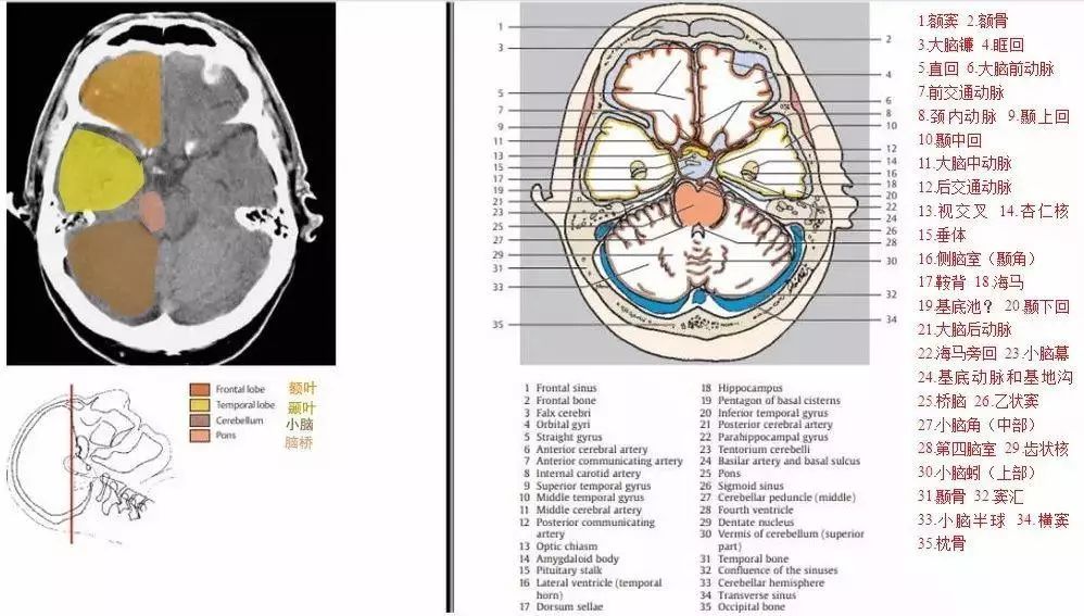 脑ct结构图解剖图高清图片