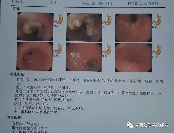 食管癌晚期的中医保守治疗案例