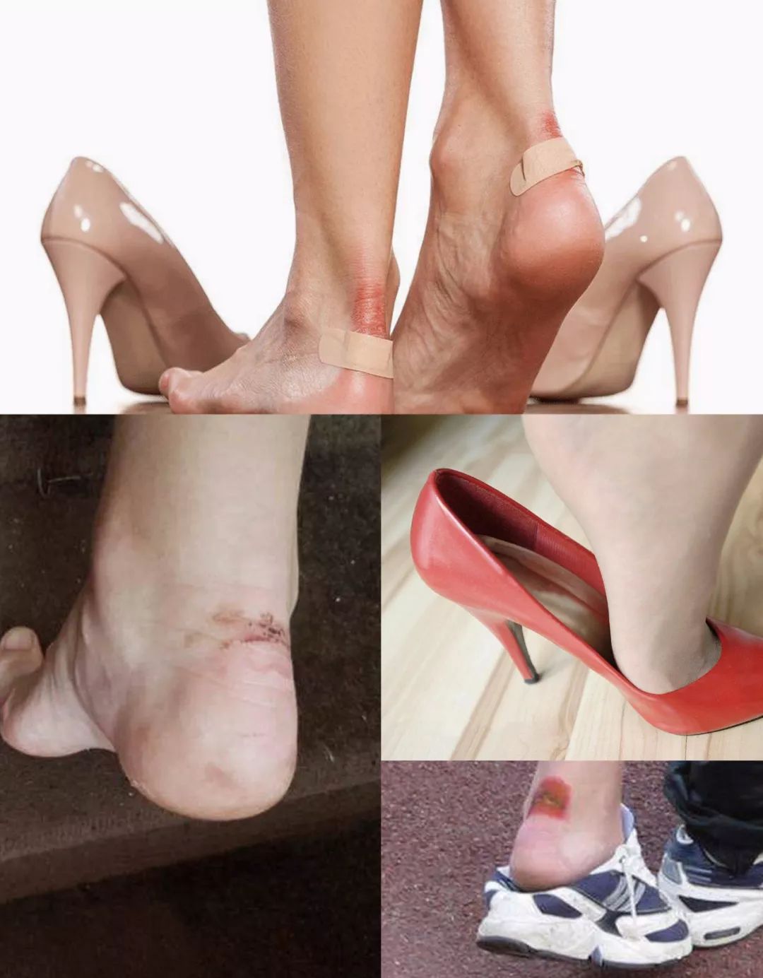 高跟鞋导致脚趾骨变形图片