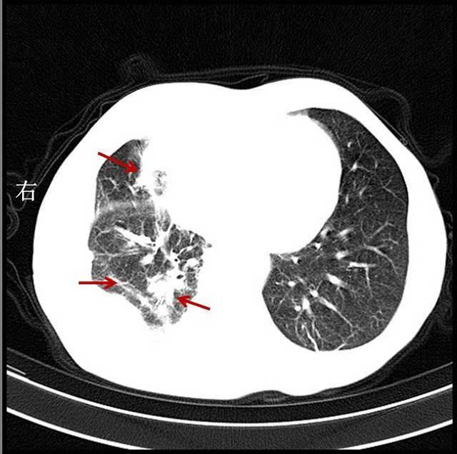 结核性胸膜炎钙化图片