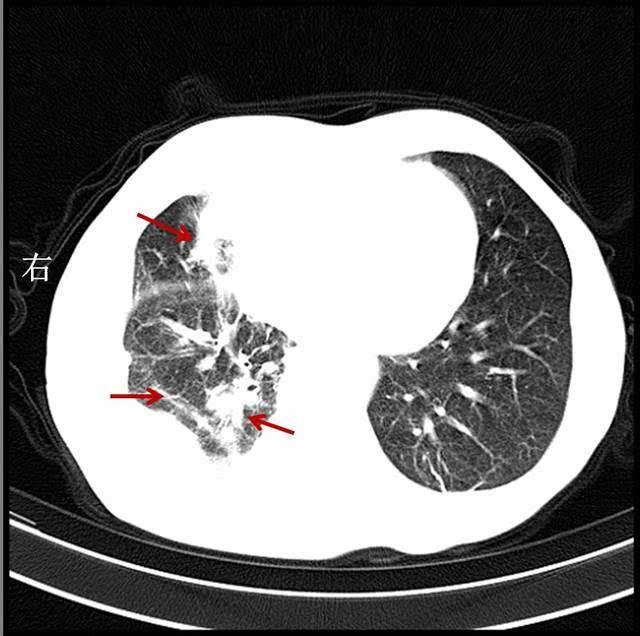 右肺中,下叶斑块状,条索状病灶,内有钙化灶番茄医生提醒,运用b超或ct
