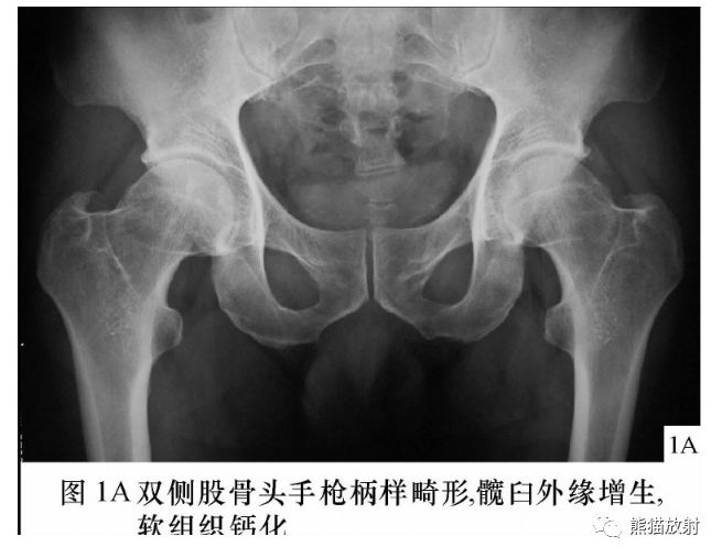 股骨髋臼撞击综合症图片