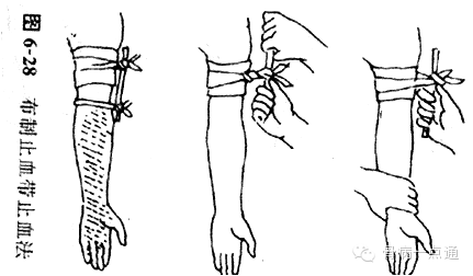 止血带绑法图片