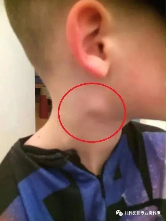 孩子脖子上有淋巴结怎么办？