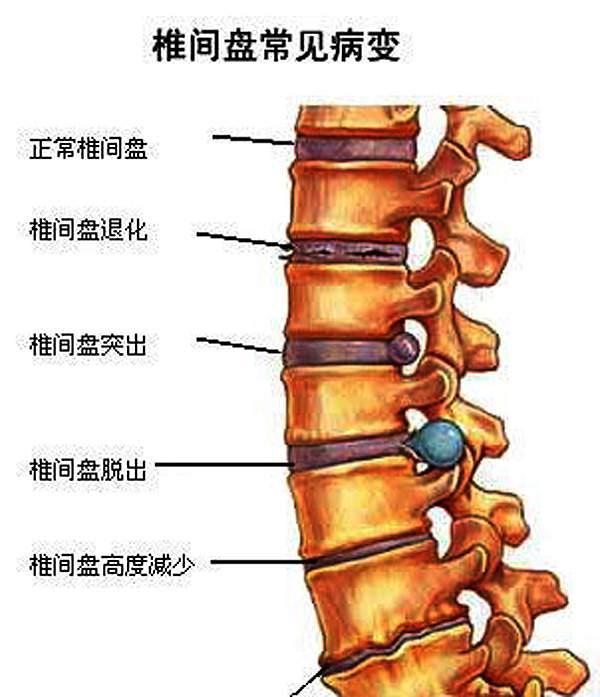 胸椎颈椎腰椎骨棘突定位图文详解