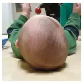 婴儿缺钙头型图片