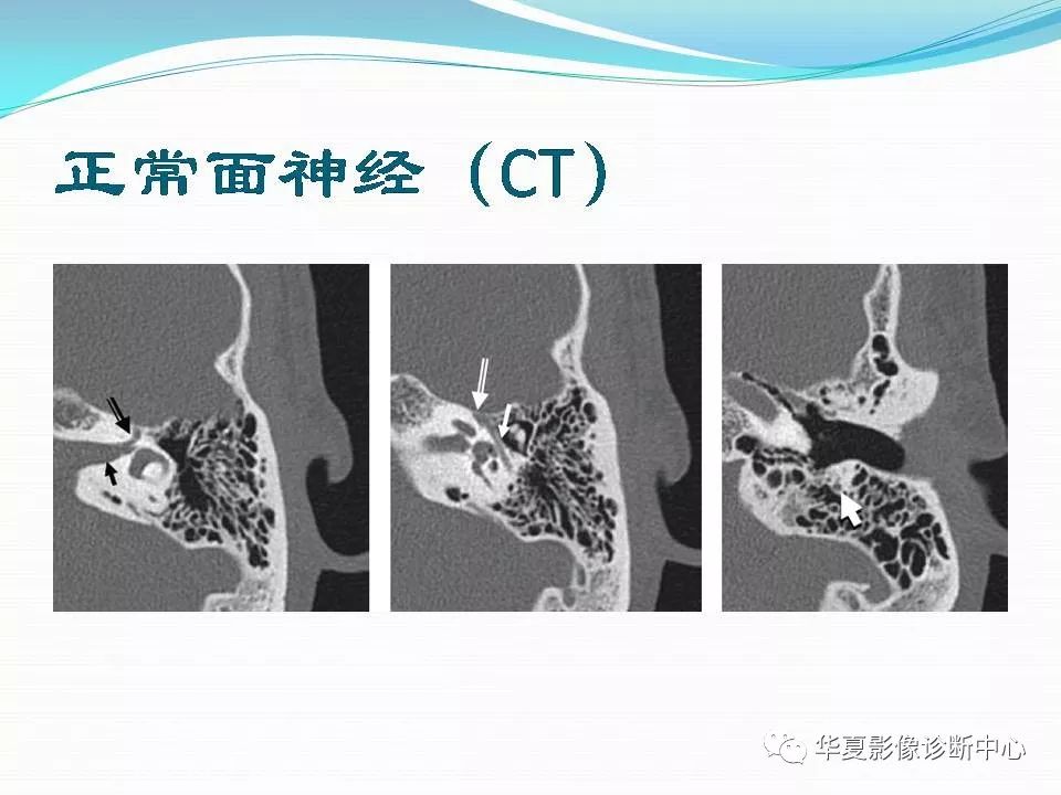 面神经管ct解剖图图片